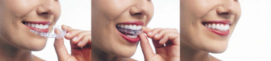 Invisalign Clear Braces Scottsdale Phoenix AZ