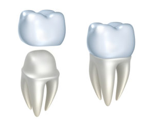 dental-crown