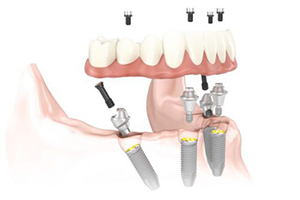 Implant dentures