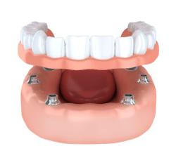 Implant dentures