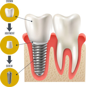 Dental Implants image