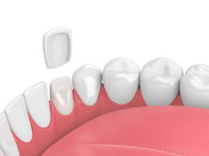 Dental Veneer Image