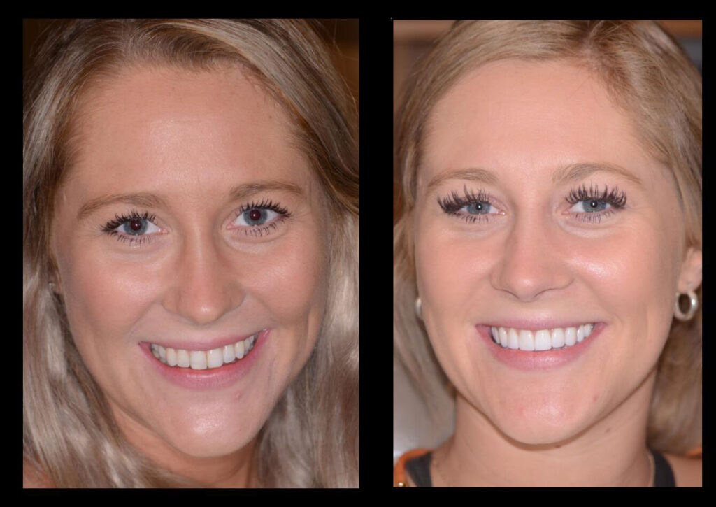 Teeth Whitening vs. Porcelain Veneers